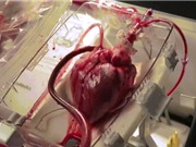CLIP: Tim người vẫn đập ngoài cơ thể khi chờ cấy ghép