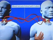 Cấy ghép đầu có thể giúp "cải lão hoàn đồng"