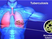 Những chú ý khi gia đình có người cao tuổi mắc bệnh lao