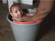Việt Nam có thể xét nghiệm virus Zika gây bệnh đầu nhỏ