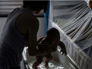Vi rút Zika có thể hủy hoại mắt của trẻ