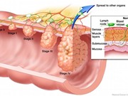 Bệnh nhân ung thư trực tràng sống được bao lâu?