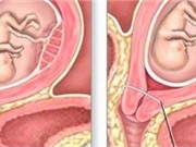 Căn bệnh khiến mẹ mất con ít người biết