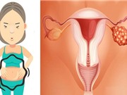 Những dấu hiệu nghi ngờ ngay đến ung thư buồng trứng