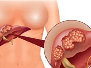 10 căn bệnh ung thư nguy hiểm nhất mọi thời đại