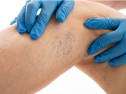 Bí quyết giúp giảm đau do giãn tĩnh mạch chân