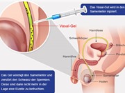Clip: Phương pháp tránh thai mới cho nam giới, hiệu quả 100%