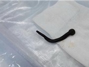 Gắp đỉa sống dài 6cm từ khí quản người đàn ông