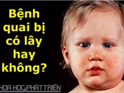 Bệnh quai bị có lây không?
