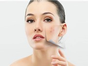 Cách bảo vệ da khi có mụn trứng cá