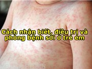 Cách nhận biết, điều trị và phòng bệnh sởi ở trẻ em
