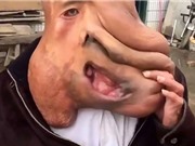 Số phận éo le của 'Người voi Trung Quốc'