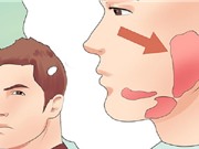 Bệnh nhân quai bị nên kiêng thứ gì?