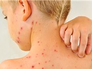 Trẻ bị sởi cần kiêng gì và cách chăm sóc trẻ tại nhà
