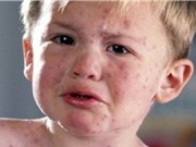 Những điều cần biết về bệnh sởi 