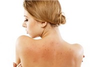 8 bài thuốc đơn giản loại bỏ trứng cá trên cơ thể