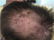 Trẻ bị chốc đầu dai dẳng có thể do bệnh hiếm gặp