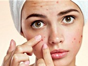 Hướng dẫn trị mụn hiệu quả tại nhà