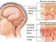 Nguyên nhân, triệu chứng và cách điều trị viêm não Nhật Bản
