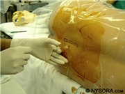 Tác dụng phụ của phương pháp gây tê tủy sống khi mổ sinh