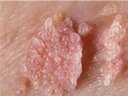 Không chỉ qua đường tình dục, bệnh sùi mào gà rất dễ lây