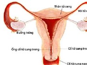 "Thủ phạm" gây ung thư cổ tử cung nhiều bạn tình nên cảnh giác