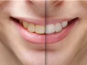 Những thực phẩm làm răng ố vàng và cách “cứu nguy” trong tích tắc