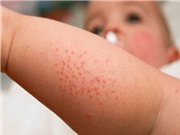 9 biện pháp đơn giản ngừa sốt xuất huyết