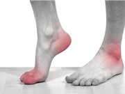 Những bài thuốc dân gian hỗ trợ điều trị bệnh gout hiệu quả