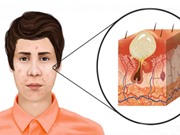 Khám phá mới về nguyên nhân gây ra mụn trứng cá