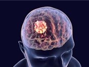 Phát hiện thuốc trị chứng sốc độ cao hữu ích cho các bệnh nhân u não