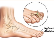 Tại sao bệnh nhân tiểu đường hay bị gãy xương?