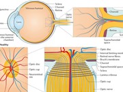 Xác định được 40 chuỗi ADN gây bệnh glaucoma dẫn tới mù lòa