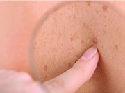 Tăng ung thư da tại các nước phát triển