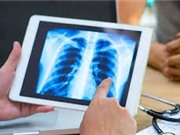 Phát hiện thuốc ngừa ung thư vú có thể giúp chống lại ung thư phổi