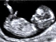 Liệu pháp gene có thể điều trị rối loạn não hiếm gặp ở thai nhi