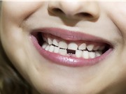 Chẩn đoán các vấn đề sức khỏe tâm thần ở trẻ em qua răng