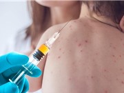 Số người mắc bệnh sởi ở Mỹ cao nhất kể từ năm 1992
