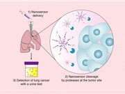Cảm biến nano giúp phát hiện sớm u phổi