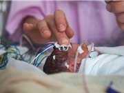 Những vấn đề sức khỏe về lâu dài ở trẻ sinh non (Phần 2)