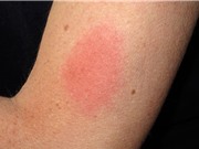 Tác dụng phụ từ vaccine Pfizer, Moderna: đau, sốt nhưng không nguy hiểm