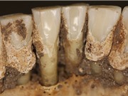 Cao răng tiết lộ thói quen dùng thuốc của người xưa