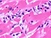 Nhiều bệnh nhân chết vì Covid-19 có virus trong tim