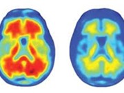 FDA phê duyệt thuốc điều trị Alzheimer mới