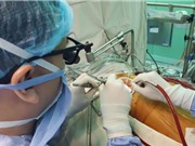 Nghiên cứu hiệu quả của phẫu thuật tim ít xâm lấn