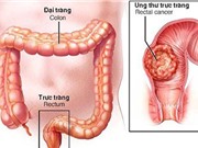 Nghiên cứu phát hiện sớm ung thư đại trực tràng 