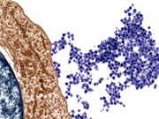 Tìm ra virus liên quan đến bệnh đa xơ cứng