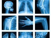 Phương pháp mới giúp đánh giá tuổi xương và xác định giới tính từ ảnh chụp X quang
