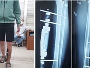 Khung cố định ngoài linh hoạt cho điều trị gãy xương 