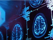 Thuốc làm chậm suy giảm nhận thức ở bệnh nhân Alzheimer
